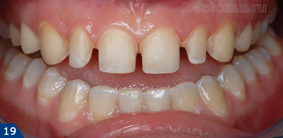 10 верхних зубов обточены под коронки Emax