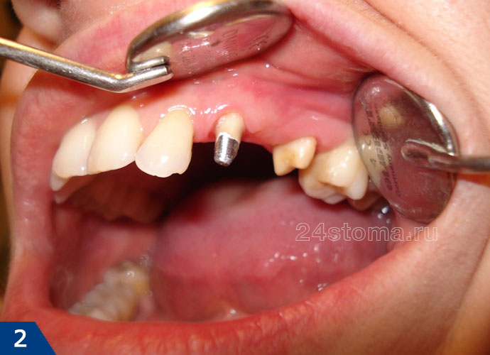 Протезирование одиночно отсутствующего зуба металлокерамическим мостовидным протезом (опорные зубы обточены под коронки)