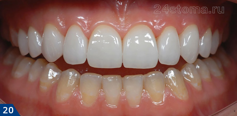 Вид готовой работы - на верхних зубах фиксировано 10 коронок из Emax