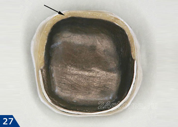 Край металлического каркаса дополнительно изолирован керамикой (только с лицевой стороны коронки)