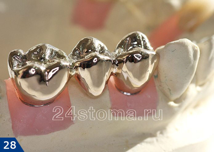 Цельнолитой мостовидный протез из трех единиц (фото сделано на гипсовой модели зубов пациента)