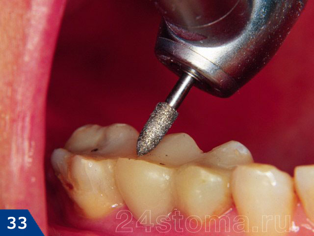 Зубы восстановлены из пломбировочного материала