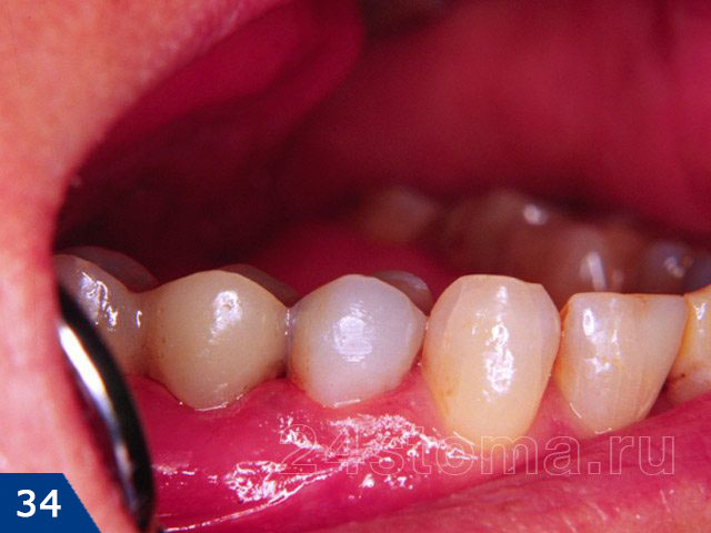 Внешний вид восстановленного зуба