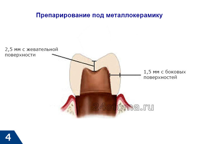 Схема препарирования зуба под металлокерамику