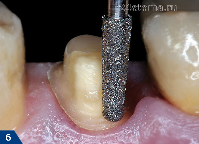 Вид обточенного под коронку зуба (в пришеечной зоне сформирован цтркулярный уступ)