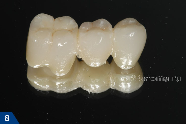 Вид изготовленного для этих зубов керамического мостовидного протеза 