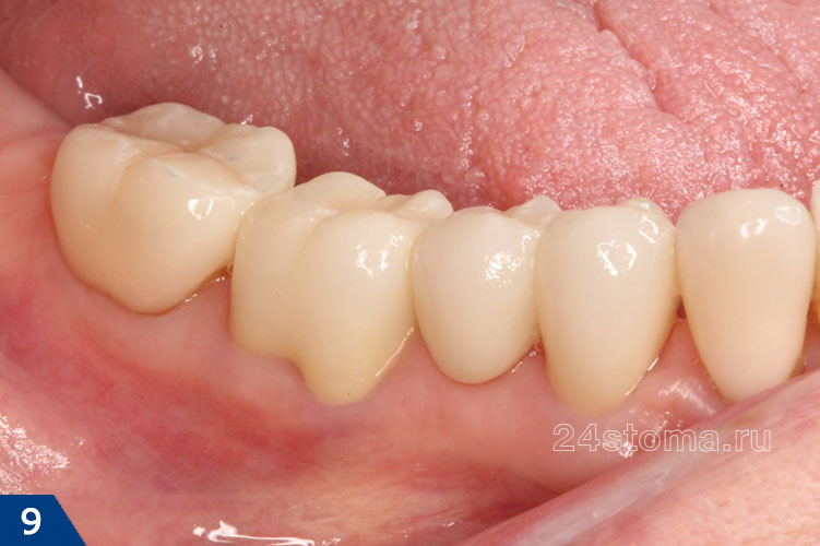 Мостовидный протез зафиксирован на 4 и 6 зубах