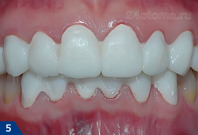 Временные мостовидные протезы из пластмассы на верхних и нижних зубах