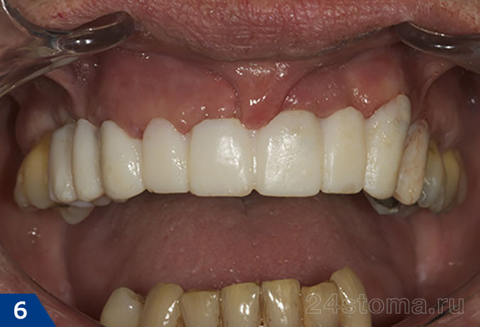 Временный мостовидный протез из пластмассы на верхних зубах