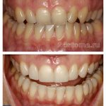 Фарфоровые виниры на зубы цена, отзывы, фото до и после