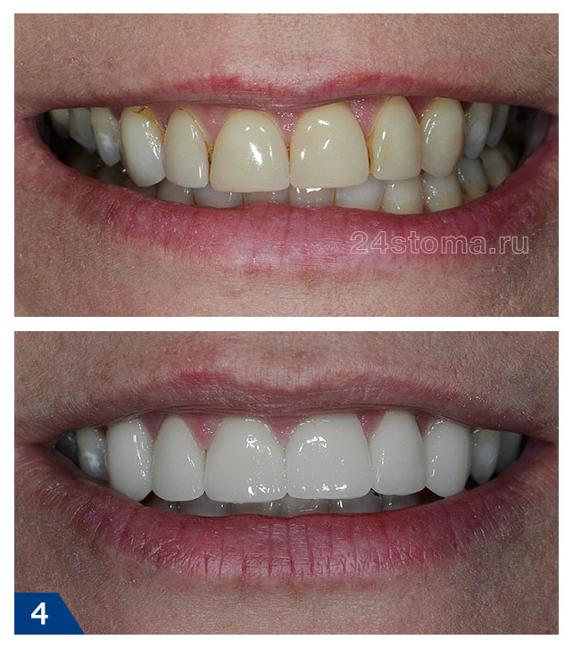 Виниры на 6 передних верхних зубов из E.max CAD - фото до и после