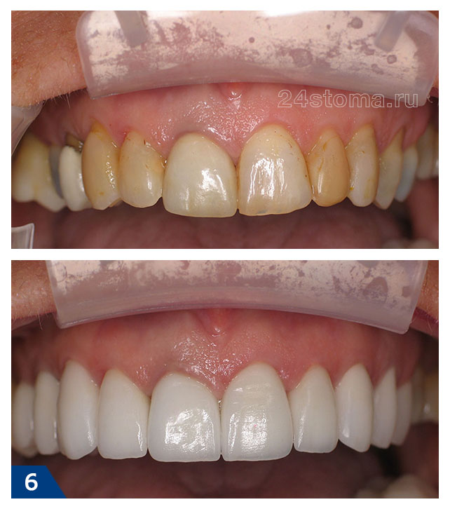 Виниры на 10 передних верхних зубов из E.max CAD - фото до и после