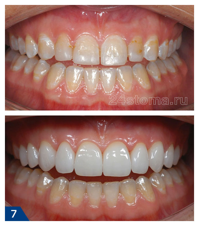 Виниры на 10 передних верхних зубов из E.max PRESS - фото до и после