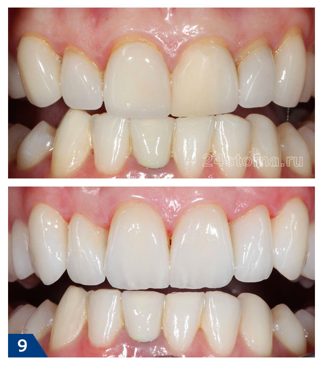 Виниры на 6 передних верхних зубов из E.max PRESS - фото до и после