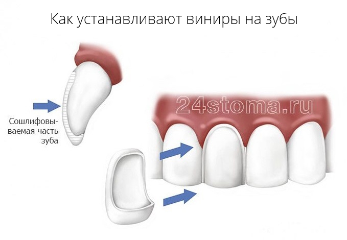 Как устанавливают виниры на передние зубы