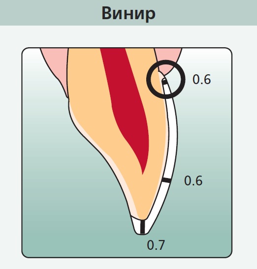 Толщина сошлифовки эмали под стандартные виниры (указано в мм)