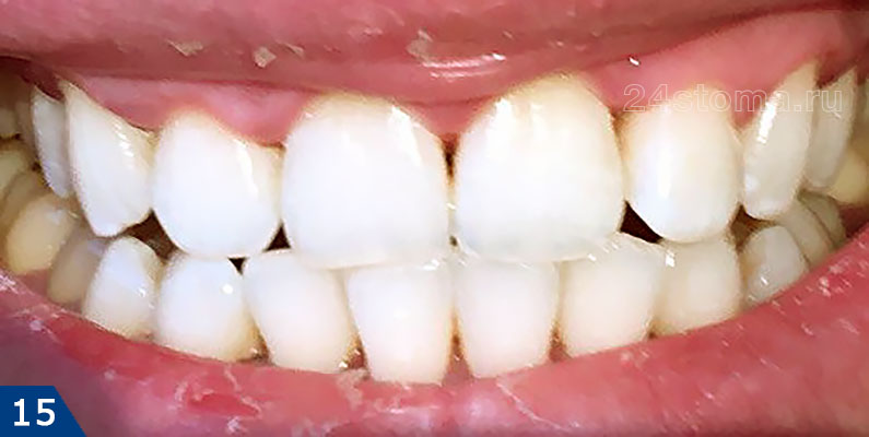 После отбеливания полосками всегда будут оставаться темные треугольники между зубами, т.к. отбеливающий гель при фиксации полосок к зубам не попадает в межзубные промежутки