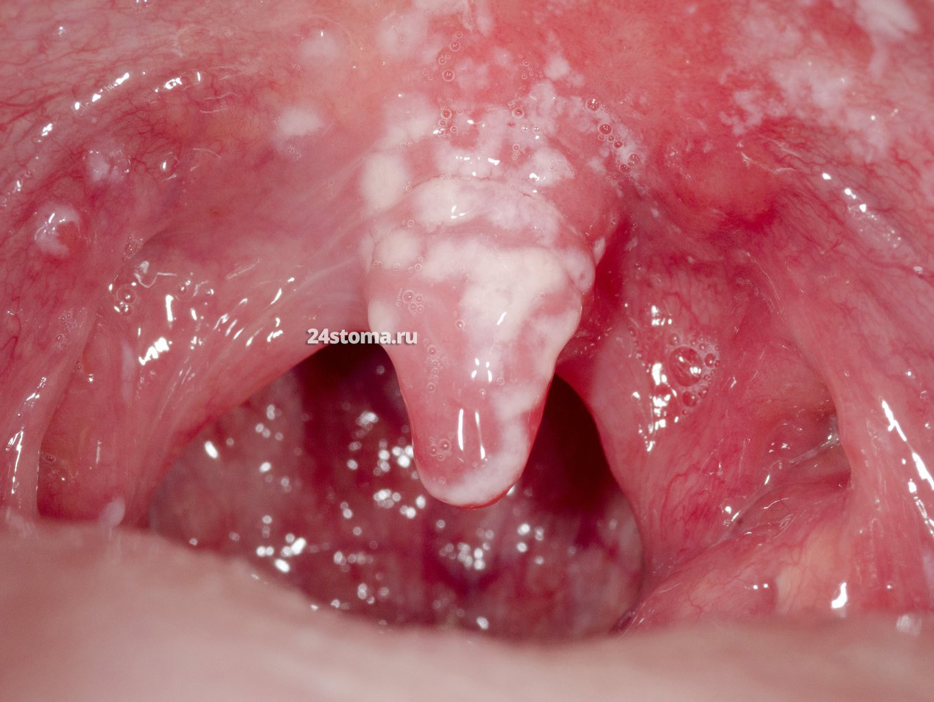 Начало молочницы полости рта (такой налёт легко соскабливается со слизистой)