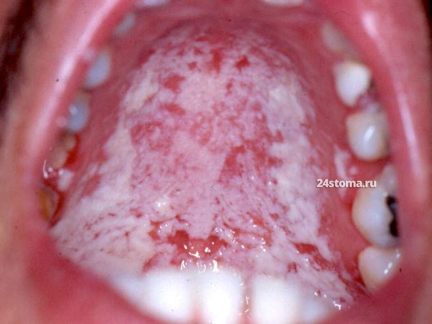 Молочница полости рта (псевдомембранозный кандидоз)
