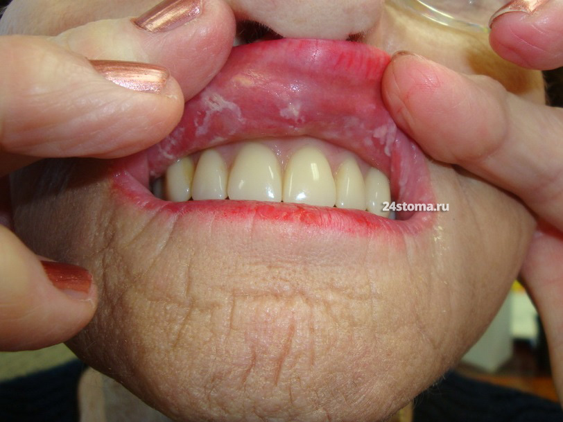 Очаги поражения грибами рода Candida на слизистой оболочке у пациента со съемным акриловым протезом на верхней челюсти. 