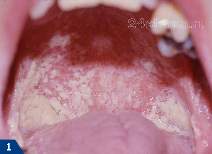 Молочница полости рта (псевдомембранозная форма)