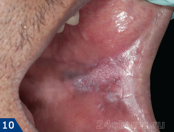 Хронический гиперпластический кандидоз с внутренней стороны угла рта (начальная стадия)