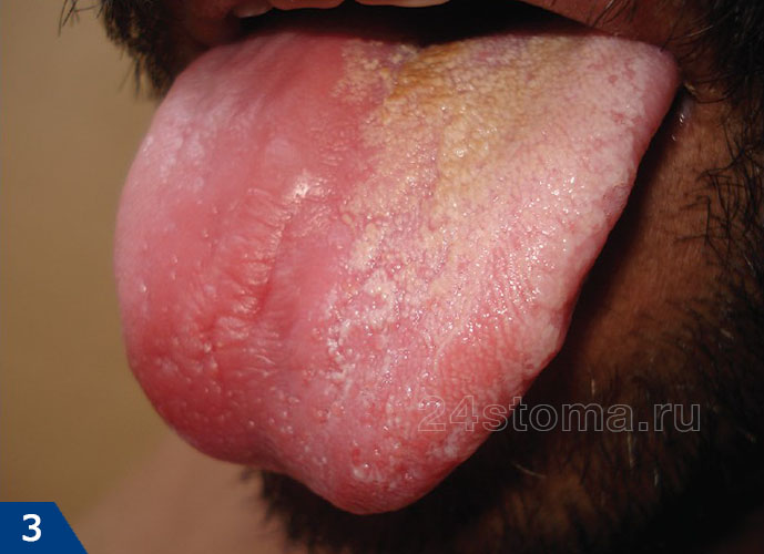 Молочница полости рта (атрофическая форма). Пораженная часть языка гладкая, лишена сосочков.