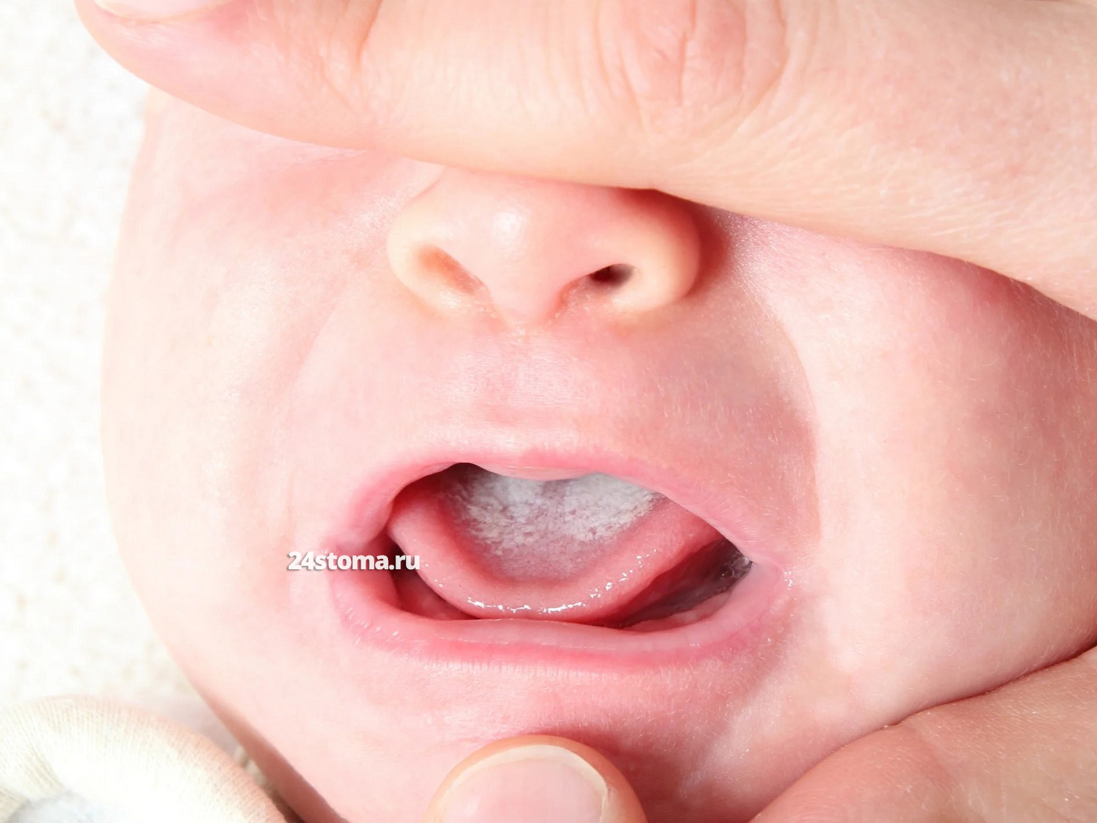Молочница у младенца во рту (на языке)
