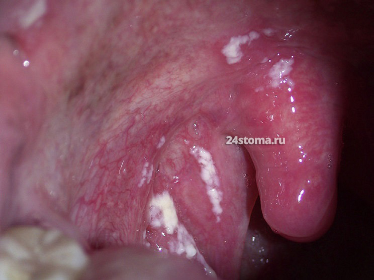 Молочница полости рта (псевдомембранозный кандидоз)