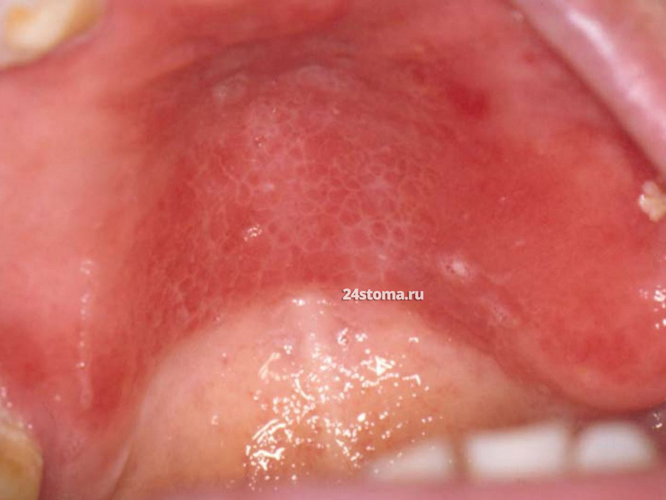 Воспалительная папиллярная гиперплазия (под съемным протезом на верхней челюсти)