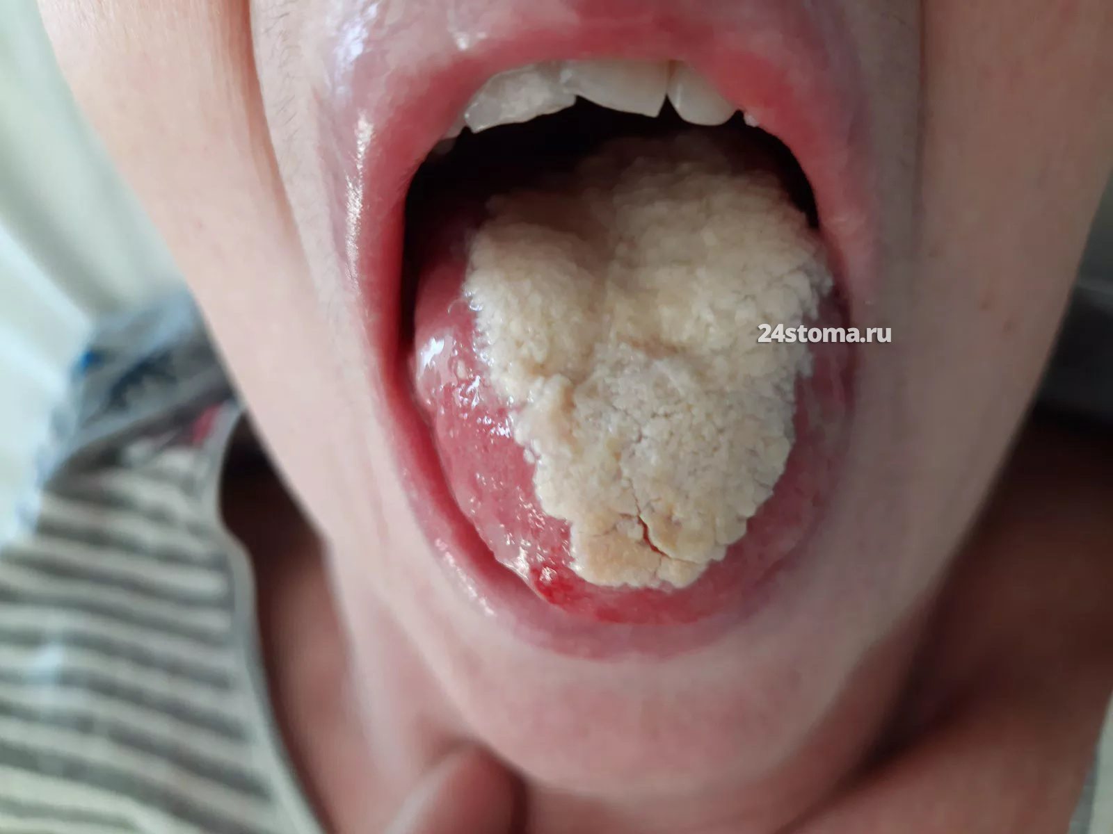 Молочница во рту у взрослых: причины, типичные симптомы, медикаментозное лечение, фото болезни