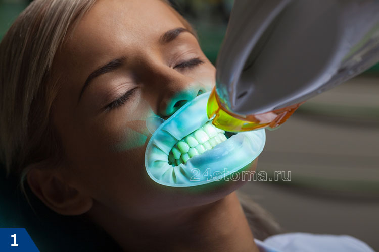 Профессиональное отбеливание зубов (при использовании источника света)