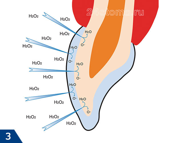Как выглядит процесс отбеливания зубов на химическом уровне (пероксид водорода H2O2 распадается на воду H2O и атомарный кислород O-)