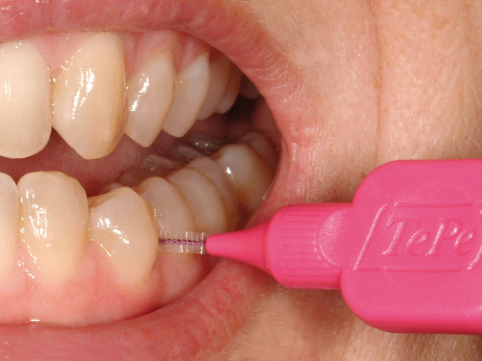 Как пользоваться ёршиком для зубов (ёршик диаметром 2,0 мм, диаметр проволоки 0,4 мм)