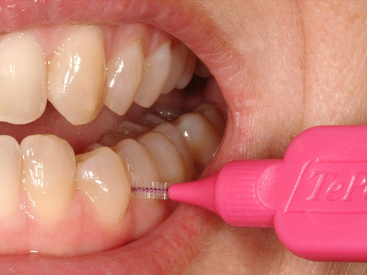 Как пользоваться ёршиком для зубов (ёршик диаметром 2,0 мм, диаметр проволоки 0,4 мм)