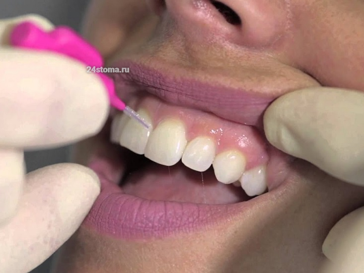 Ершик для зубов стоматологический