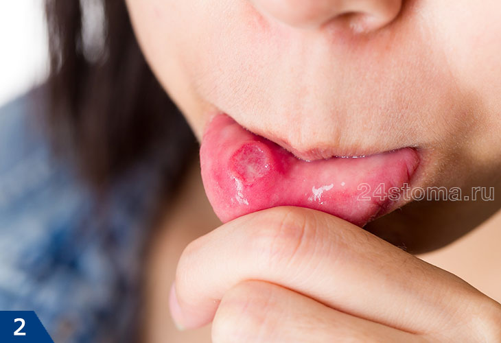 Афтозный стоматит с внутренней стороны губы у ребенка