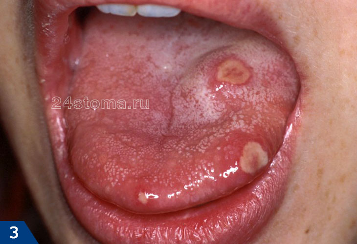 Афтозный стоматит на языке у ребенка (3 очага)