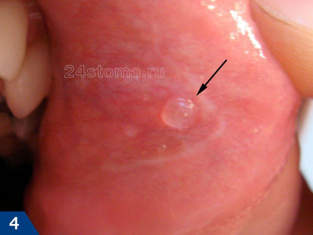 Герпетический пузырек (везикула) на слизистой оболочке полости рта