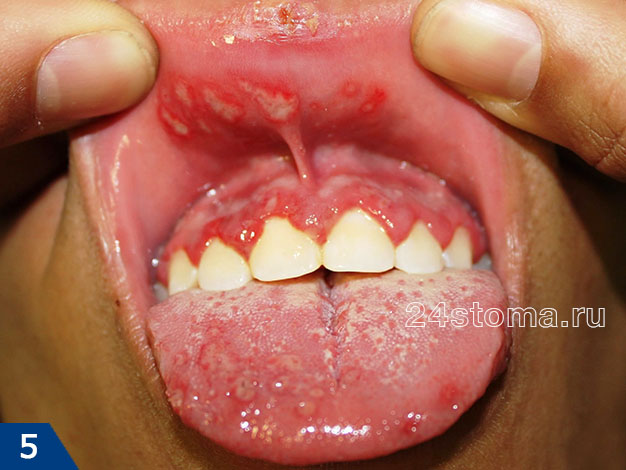 Тяжелая форма герпетического гингивостоматита (с пораженем языка, десен, слизистой оболочки губ)