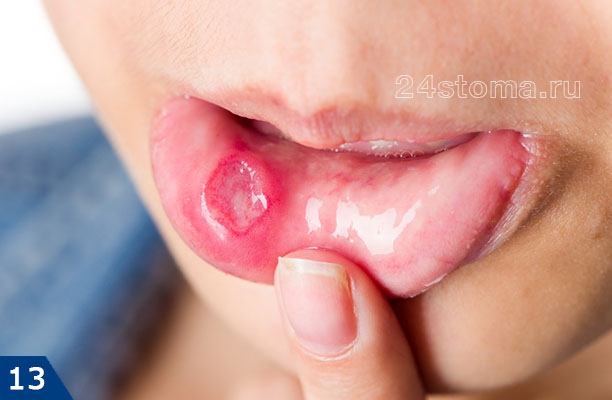 Афтозный стоматит на слизистой оболочке с внутренней стороны губы