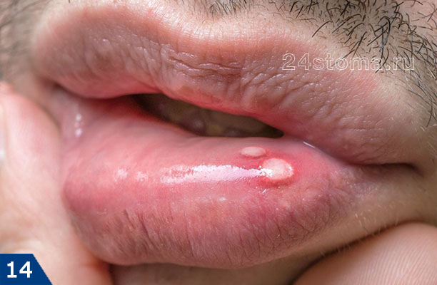 Афтозный стоматит на нижней губе (две одиночных афты белого цвета)
