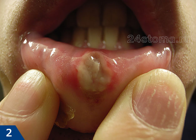 Афтозный стоматит на слизистой оболочке губы