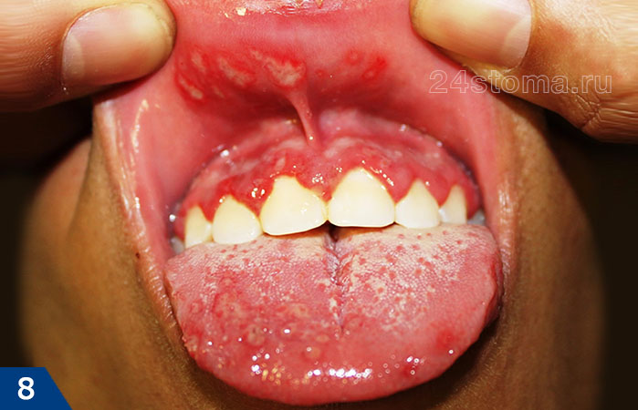 Тяжелый герпетический стоматит с поражением слизистой губы, десен, языка