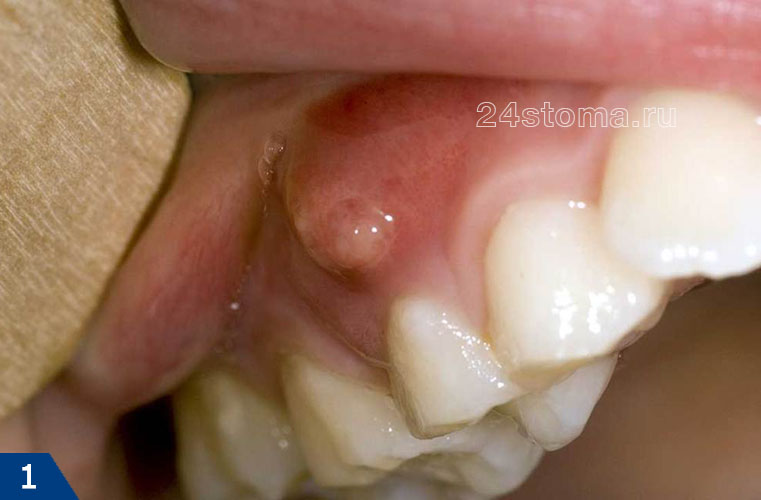 Опухла десна у ранее леченного зуба (обострение хроническиго периодонтита)