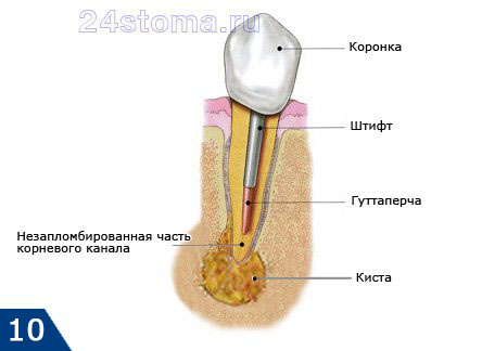 Схема образования очага гнойного воспаления у верхушки корня (кисты) при недопломбированном до верхушки корня канале зуба