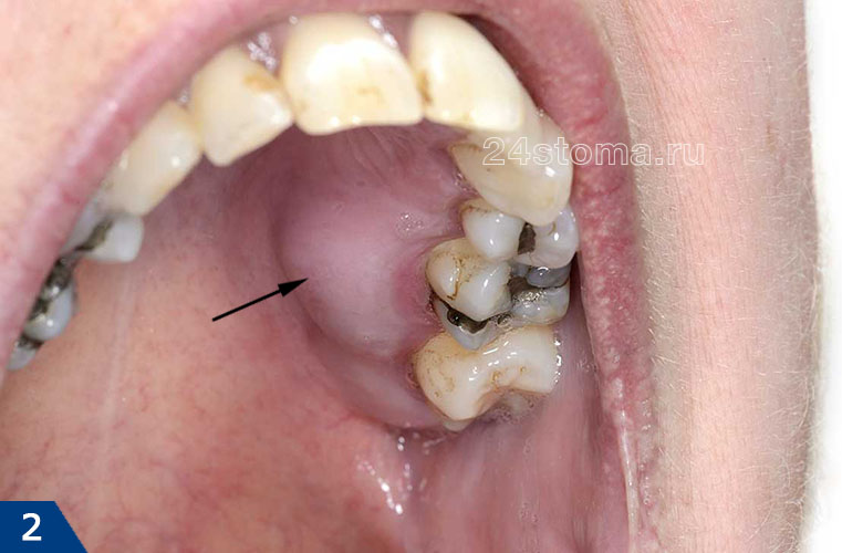 Опухла десна у ранее леченного зуба (обострение хроническиго периодонтита)
