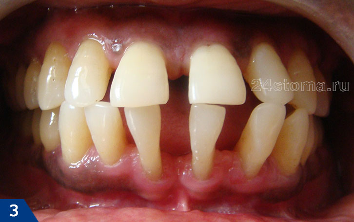 Пародонтоз тяжелой степени с веерообразным расхождением зубов