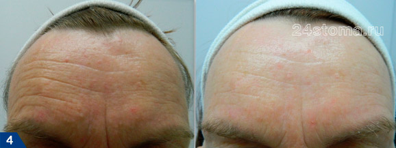 Дермапен: фото  до и после курса лечения