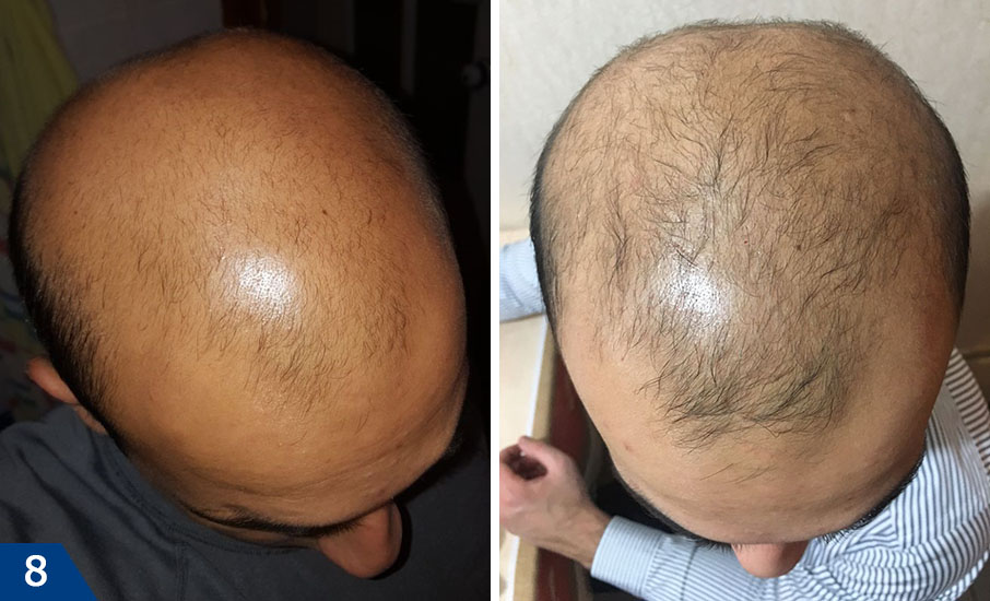 Мезотерапия для волос фото до и после (взято с сайта компании Мезофарм www.mesopharm.ru)